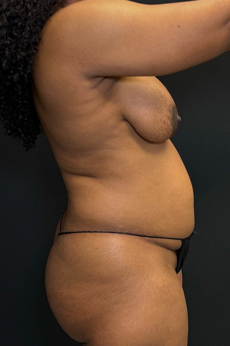 HD Liposuction 360  Before & After Gallery - Patient 156318 - Image 7