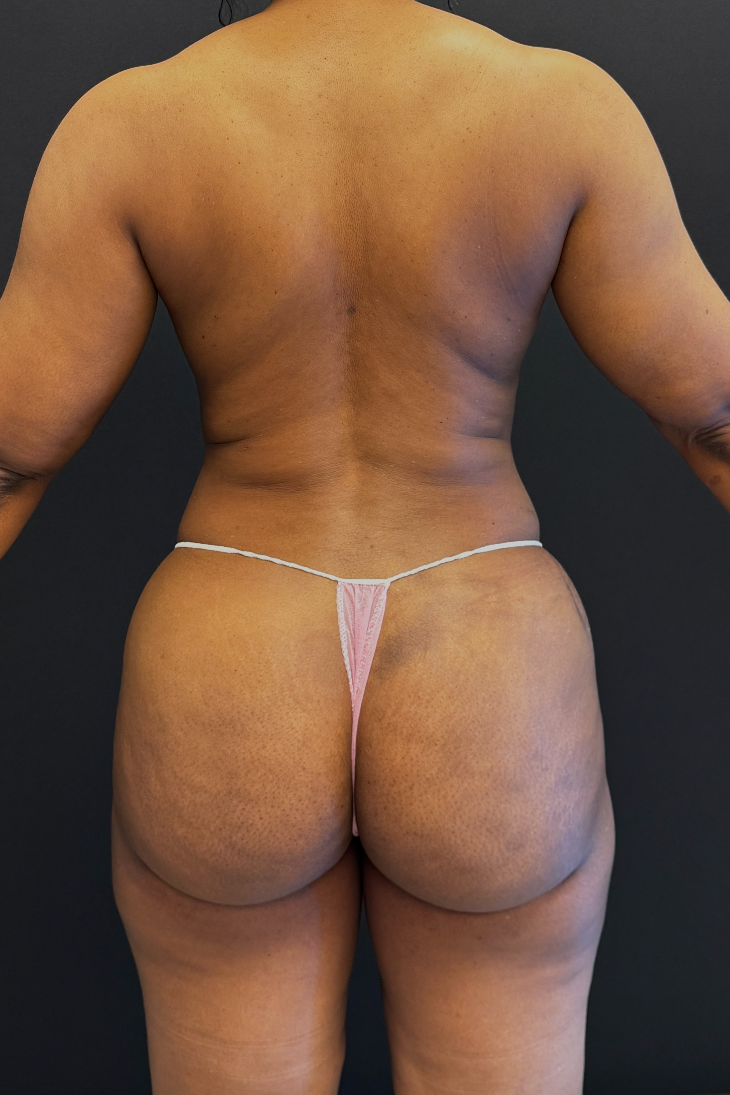 HD Liposuction 360  Before & After Gallery - Patient 156318 - Image 16
