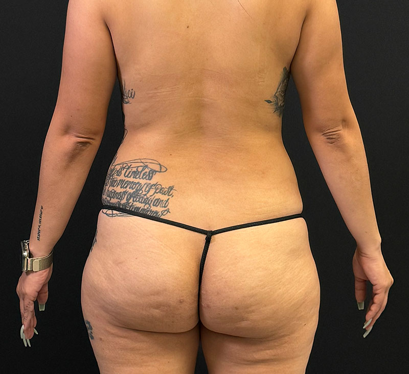 HD Liposuction 360  Before & After Gallery - Patient 334207 - Image 11