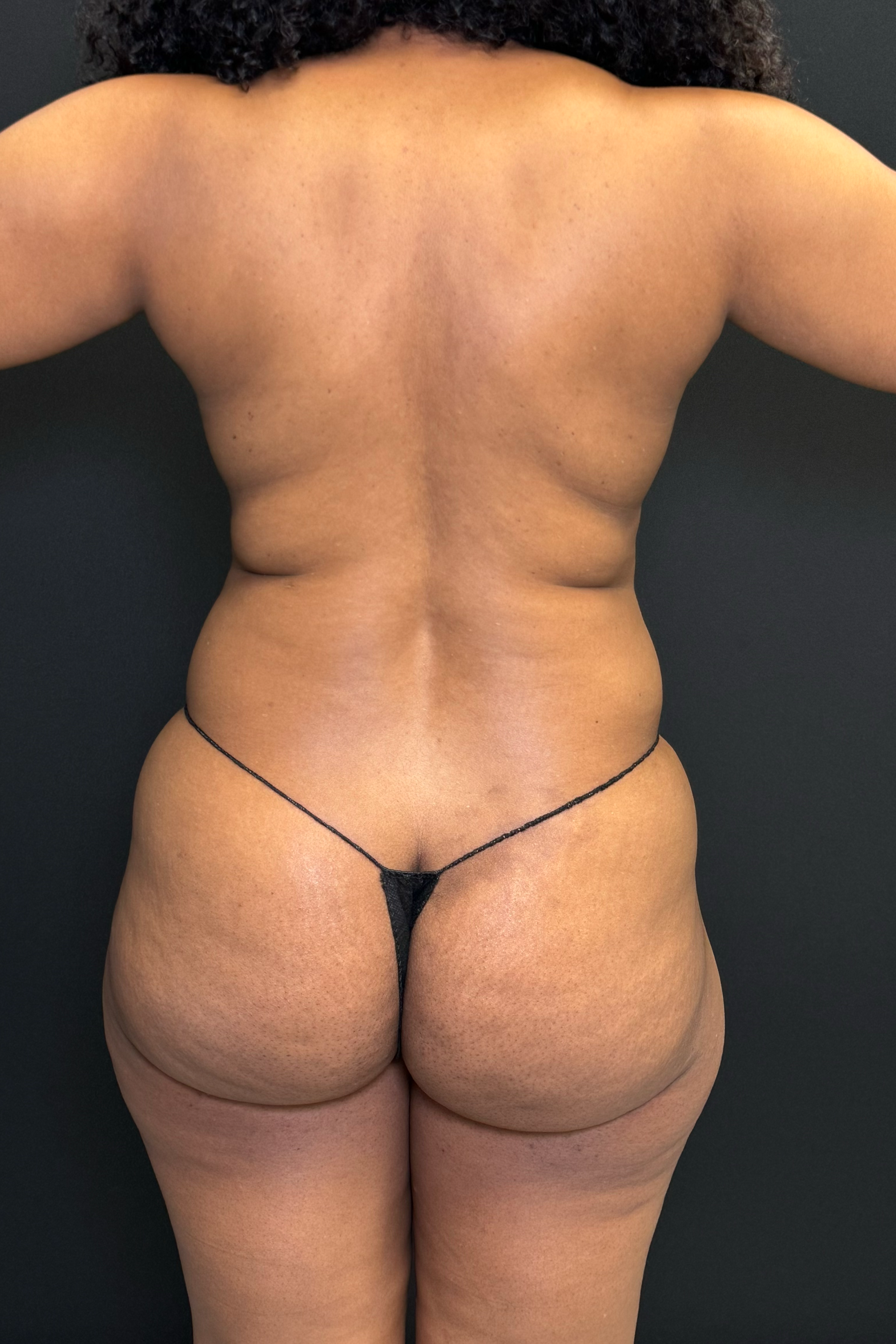 HD Liposuction 360  Before & After Gallery - Patient 156318 - Image 15